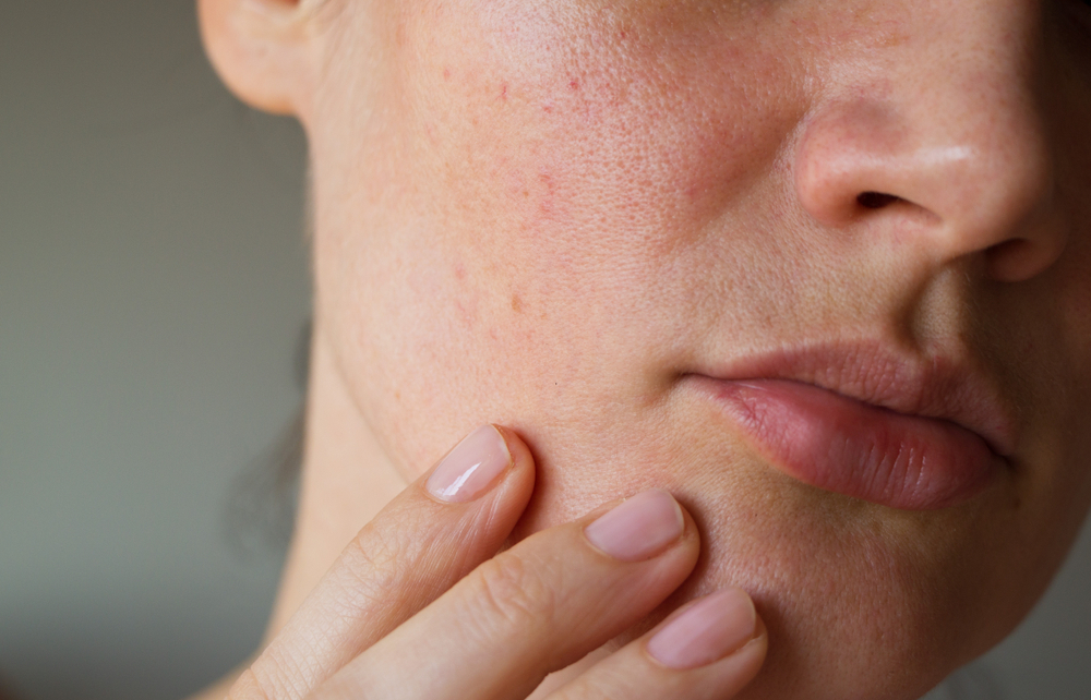 Causes et traitements de la peau granuleuse - Le Mag Beauté