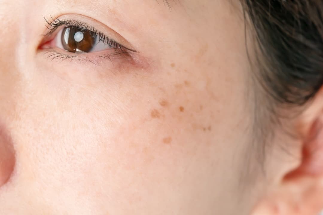 traiter tache pigmentaire sur la peau du visage 